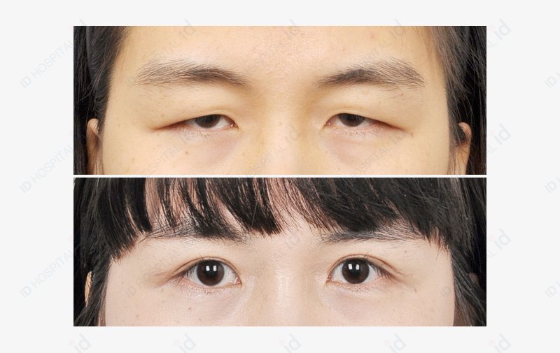 รีวิวศัลยกรรมเกาหลีจริง แนะนำเคสรีวิวเสริมจมูกและตาหวาน โดย Queen Surgery