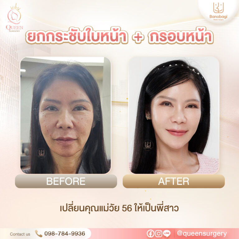 Bf Af Banobagi queen surgery แนวตั้ง ยกกระชับใบหน้า + กรอบหน้า 01