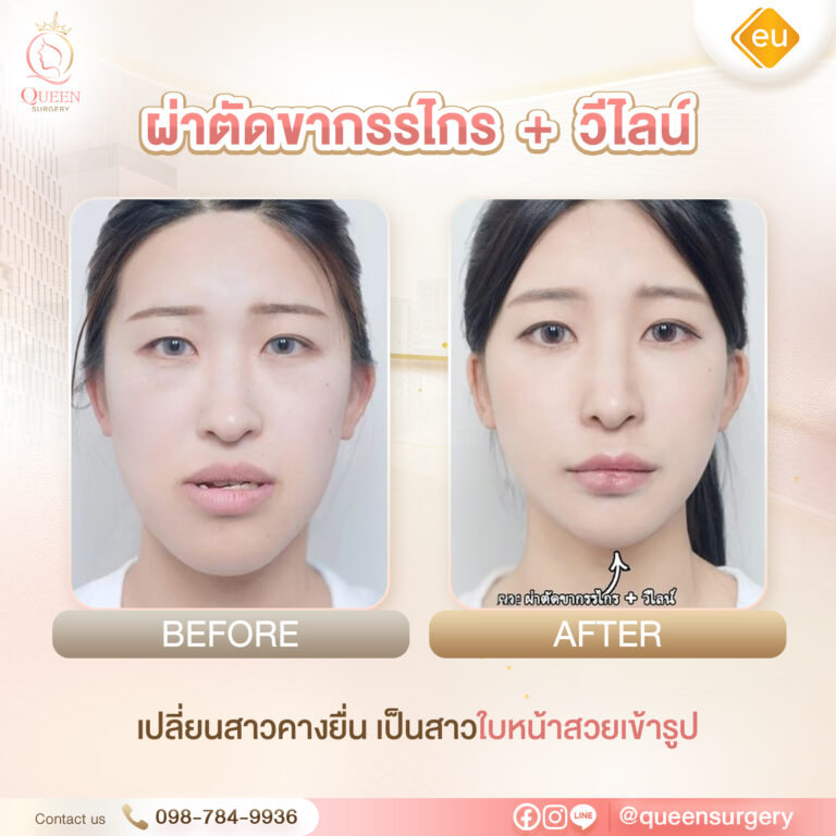 Bf Af eu queen surgery แนวตั้ง ผ่าตัดขากรรไกร + วีไลน์ 01
