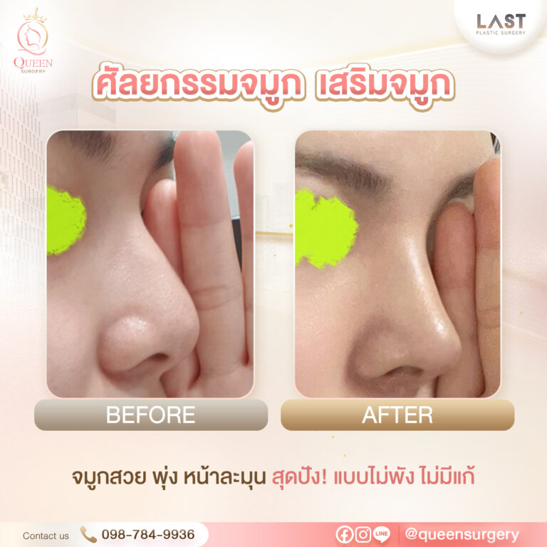 รพ. last queen surgery เสริมจมูก ศัลยกรรมจมูก 03
