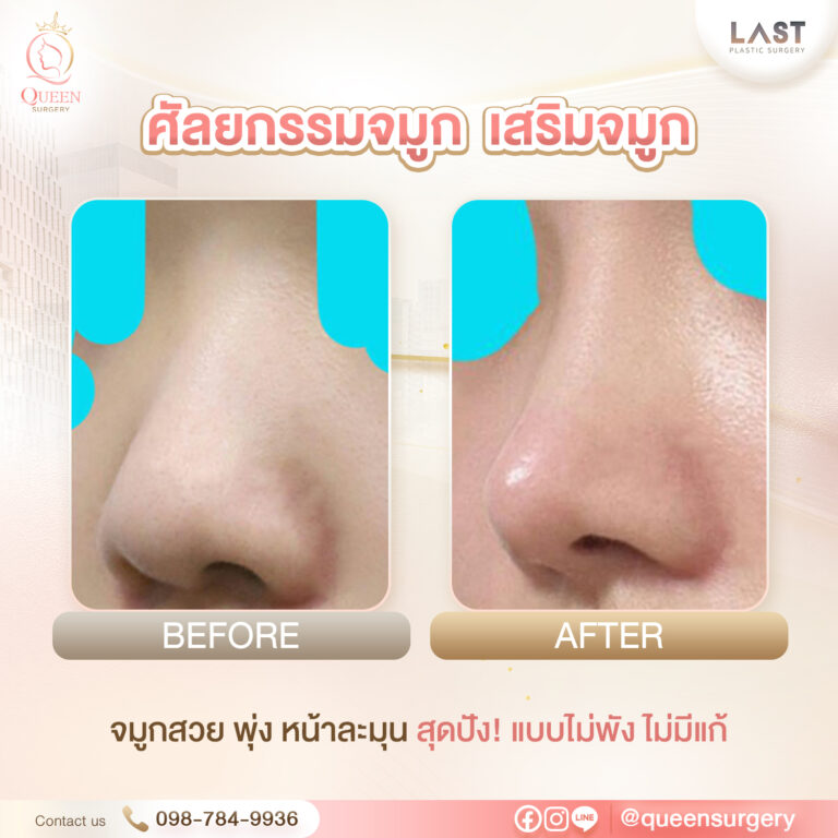 รพ. last queen surgery เสริมจมูก ศัลยกรรมจมูก ก่อนและหลัง
