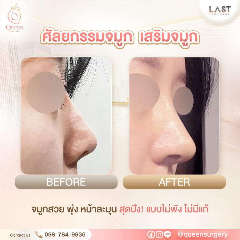 Bf Af รพ.last queen surgery เสริมจมูก ศัลยกรรมจมูก 05