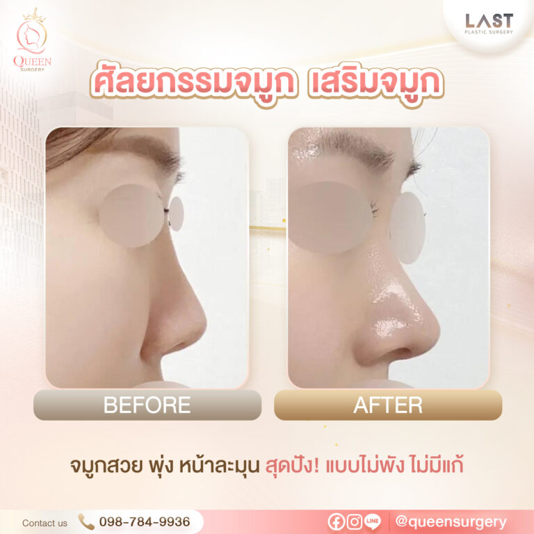 รพ. last queen surgery เสริมจมูก ศัลยกรรมจมูก