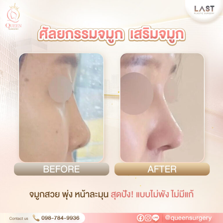 รพ.last queen surgery เสริมจมูก ศัลยกรรมจมูก
