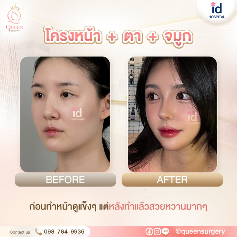 Bf Af รพ.ไอดี queen surgery เสริมจมูก + โครงหน้า + ตา 02