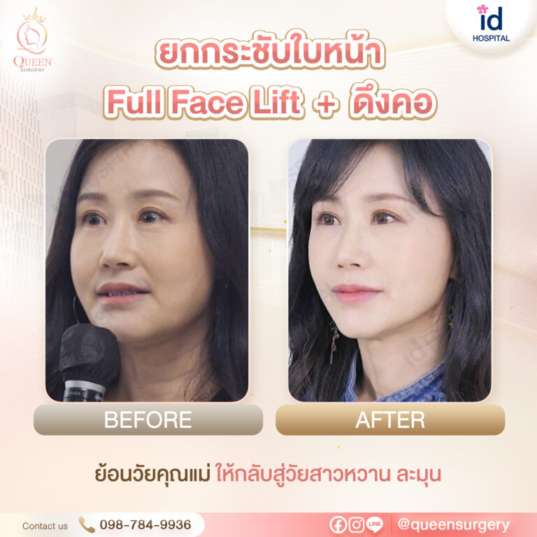 Bf Af ไอดี queen surgery ยกกระชับใบหน้า fullface + ดึงคอ 01