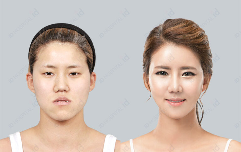 ศัลยกรรมเกาหลีที่ไหนดี โรงพยาบาลไอดี