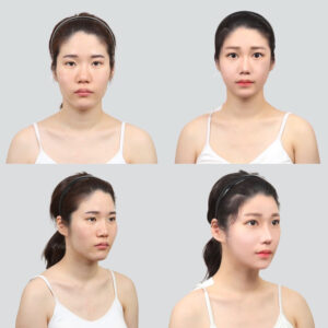 ศัลยกรรมเกาหลี อันดับ 1