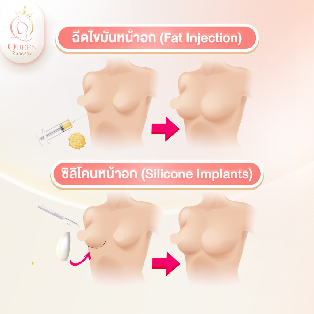 เสริมหน้าอก วิธีไหนดี ฉีดไขมันหน้าอก vs ซิลิโคนหน้าอก 1 queen surgery