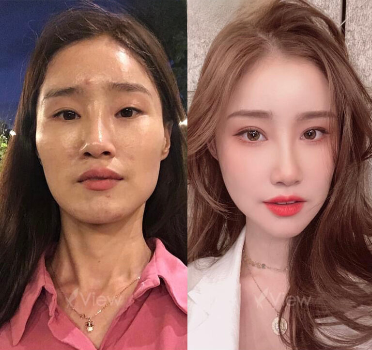 ศัลยกรรมโครงหน้า 3 จุด