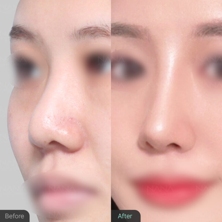 ทำศัลยกรรมจมูกที่เกาหลี