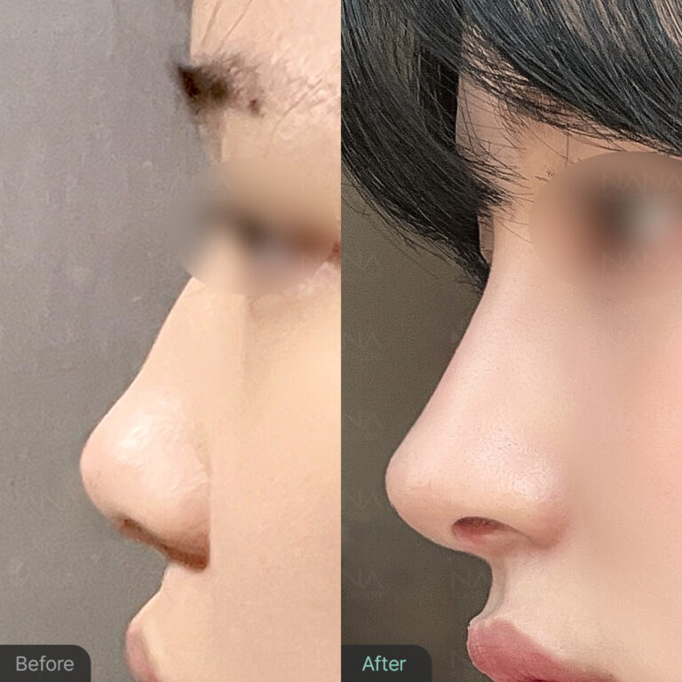ศัลยกรรมจมูก ทำไมถึงเอียง แก้ไขยังไง