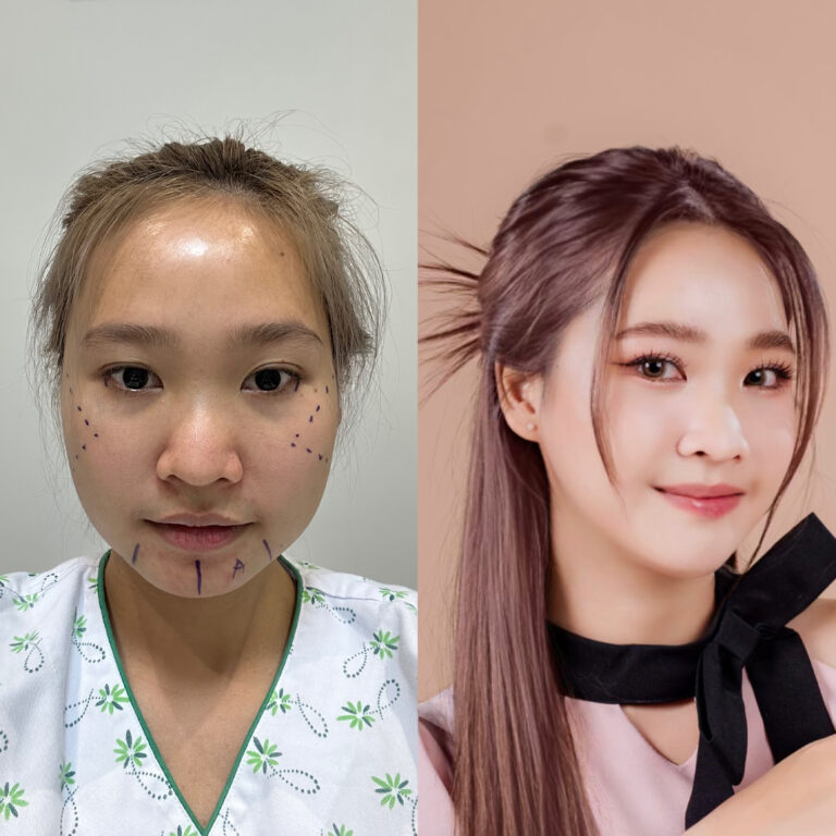 ศัลยกรรมโครงหน้า 3 จุด