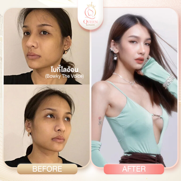 Bf Af queen surgery รพ Banobagi โครงหน้า+จมูก 01