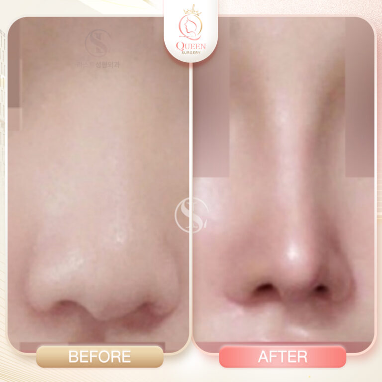 โรงพยาบาลศัลยกรรมเกาหลี ลาสท์ Last Plastic queen surgery รพ LAST ทำจมูก