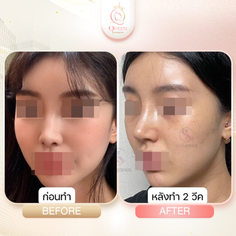 ศัลยกรรมเกาหลีที่ไหนดี Bf Af queen surgery รพ LAST โครงหน้า 02