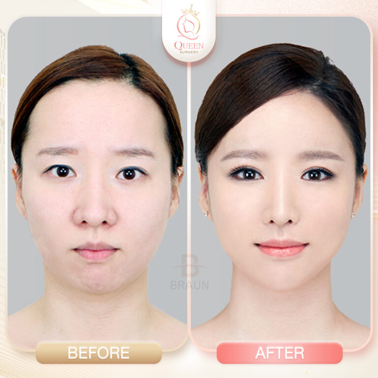 Bf Af queen surgery รพ braun 01