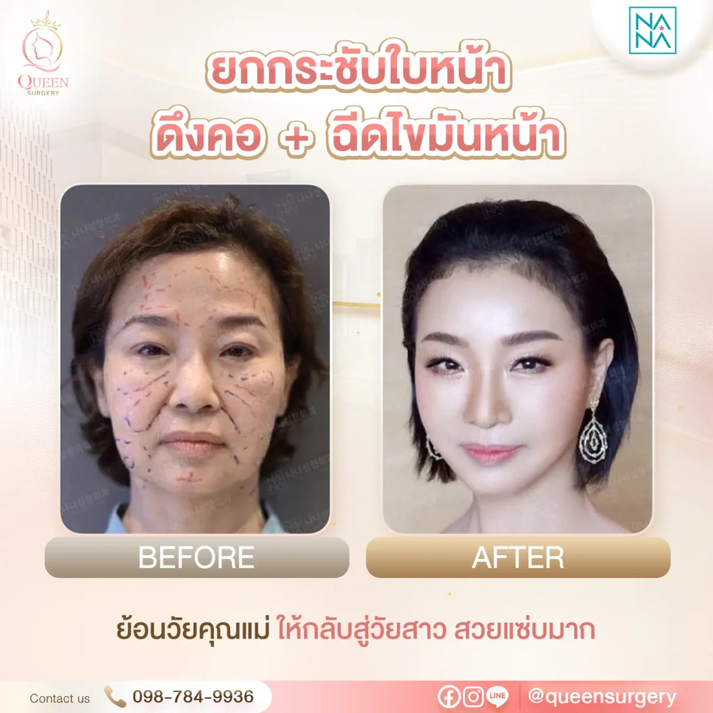 Bf Af นานะ queen surgery ยกกระชับ fullface ดึงคอ ฉีดไขมันหน้า 01