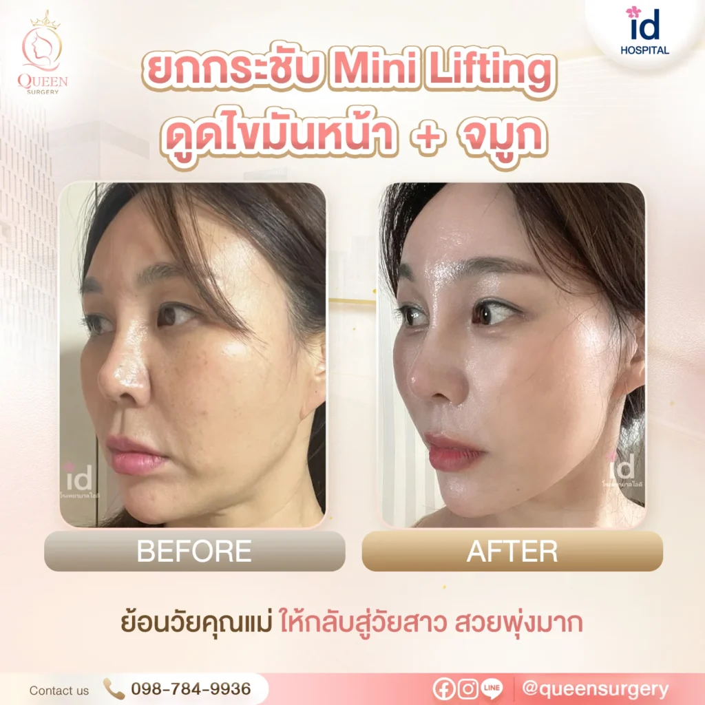 ยกกระชับใบหน้า Mini Lifting Bf Af ไอดี queen surgery ดูดไขมันใบหน้า ยกกระชับ mini lifting จมูก 01