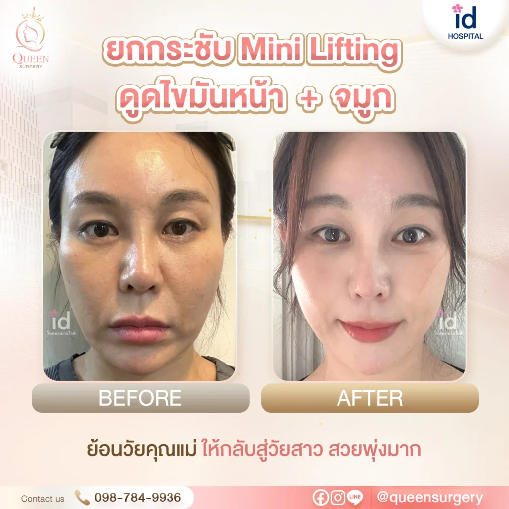 ยกกระชับ Mini Lifting Bf Af ไอดี queen surgery ดูดไขมันใบหน้า ยกกระชับ mini lifting จมูก 02
