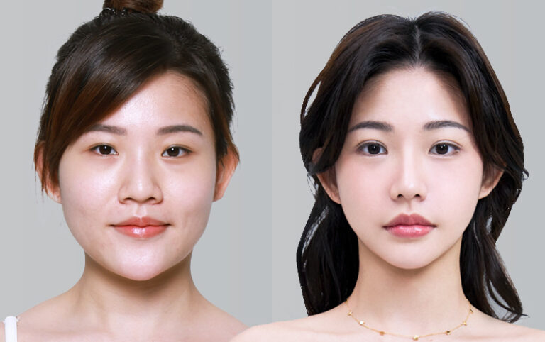 DOUBLE EYELID SURGERY, RHINOPLASTY, FACIAL CONTOURING CHEEKBONE REDUCTION+JAW ANGLE REDUCTION+GENIOPLASTY