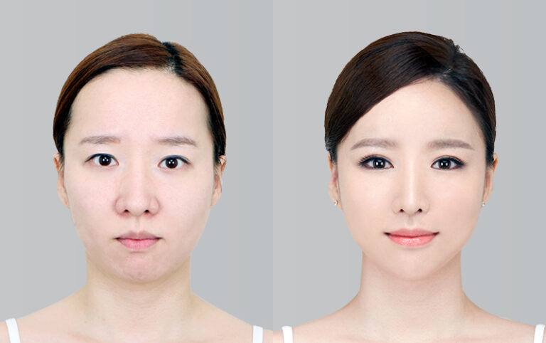 FACIAL CONTOURING CHEEKBONE REDUCTION+JAW ANGLE REDUCTION+GENIOPLASTY 1