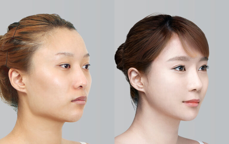 FACIAL CONTOURING CHEEKBONE REDUCTION+JAW ANGLE REDUCTION+GENIOPLASTY 2