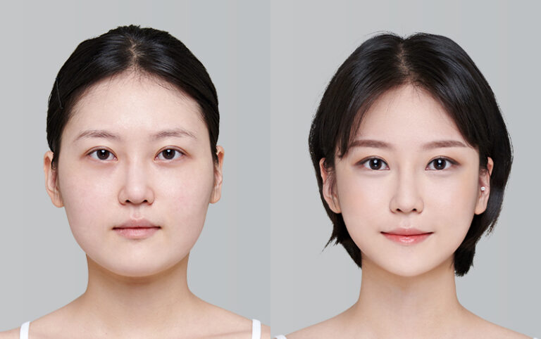 FACIAL CONTOURING CHEEKBONE REDUCTION+JAW ANGLE REDUCTION+GENIOPLASTY