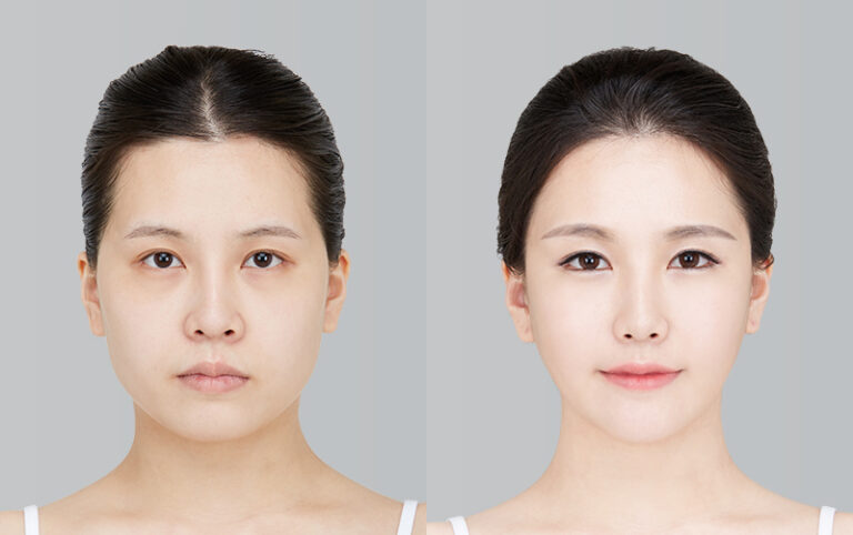 FACIAL FAT GRAFTING 1