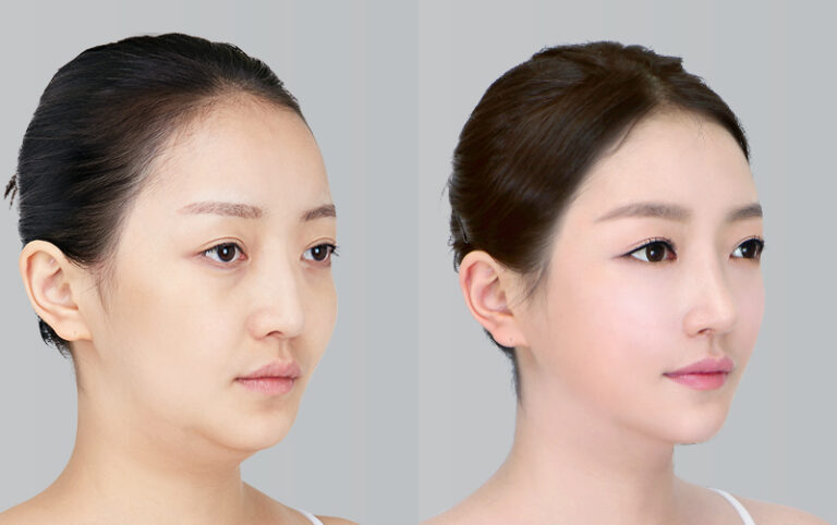FACIAL FAT GRAFTING+FACIAL LIPOSUCTION CHIN