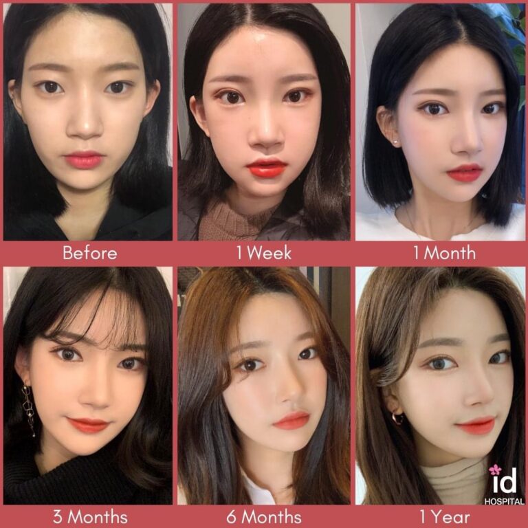 ทำศัลยกรรมโครงหน้าสามจุด