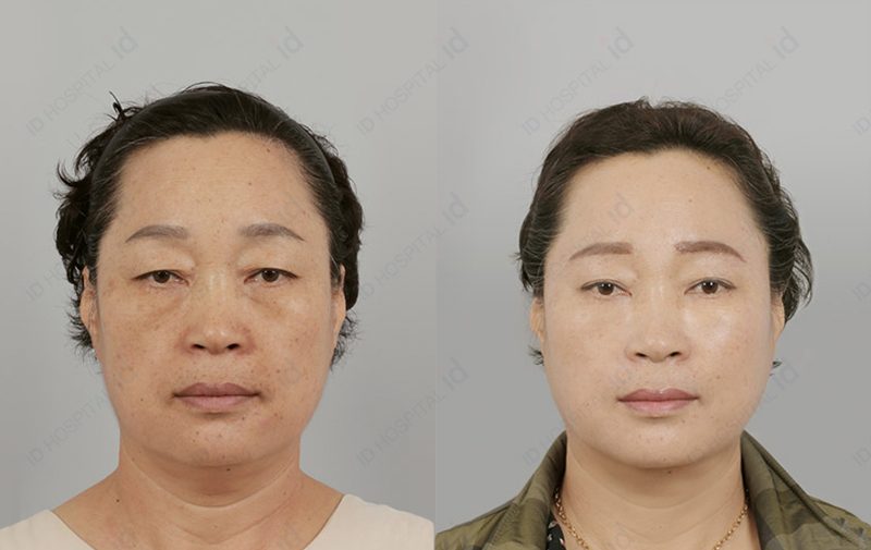 หน้าโทรม หลังคลอด ศัลยกรรมเกาหลีช่วยได้