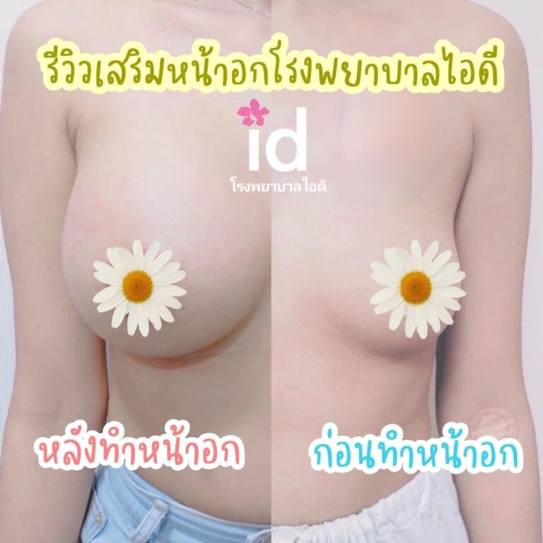 ทำศัลยกรรมหน้าอกที่เกาหลี