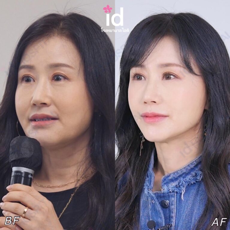 ยกกระชับหน้าที่เกาหลี ดึงหน้า