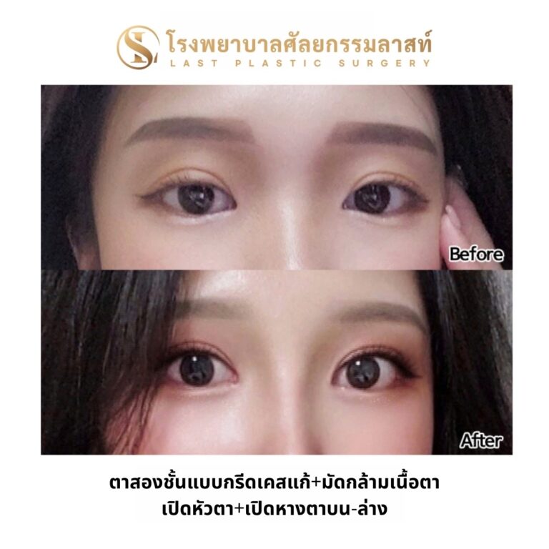โรงพยาบาลศัลยกรรมเกาหลี ลาสท์ Last Plastic