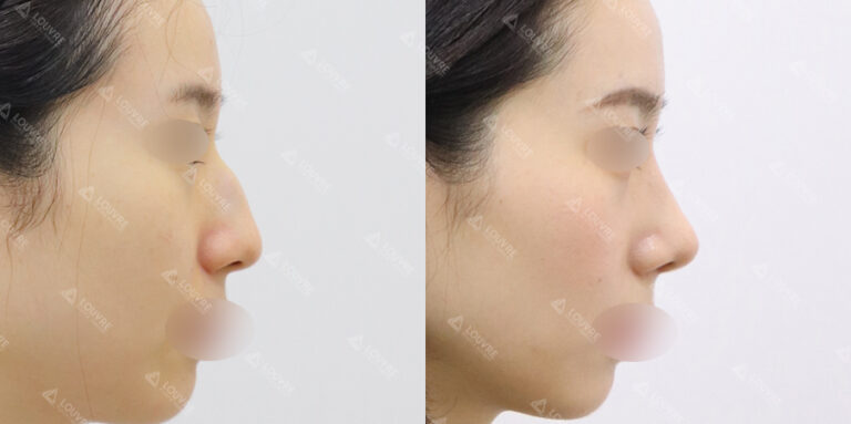 Louvre nose