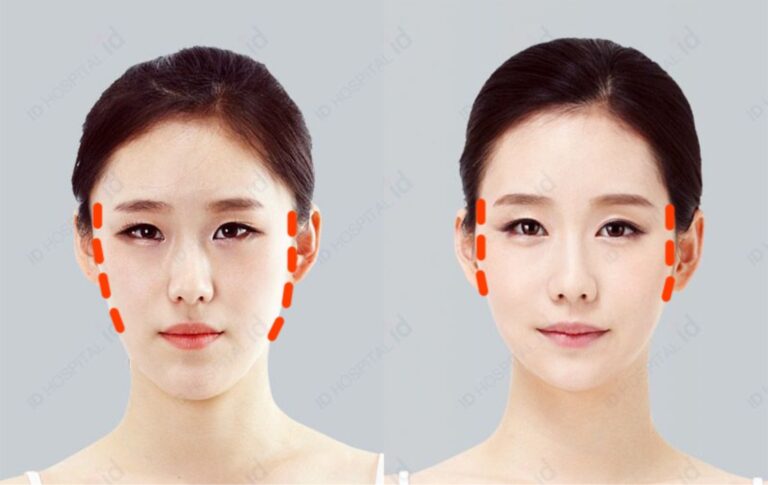 คางสั้น หน้ายาว ศัลยกรรมเกาหลี