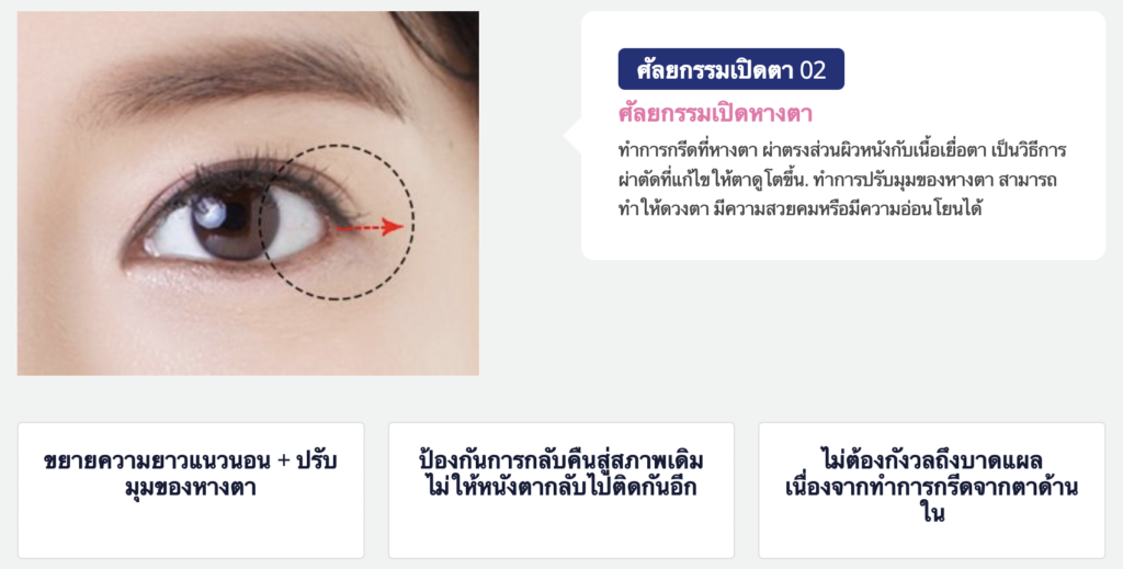 ศัลยกรรมเปิดตา ศัลยกรรมเปิดหางตา