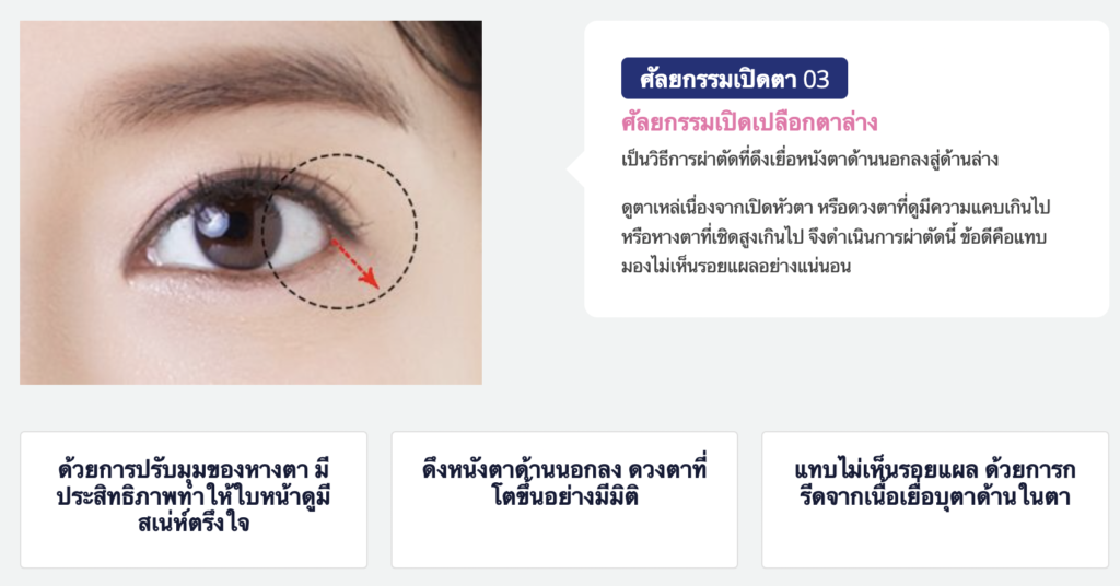 ศัลยกรรมเปิดตา ศัลยกรรมเปิดหางตา