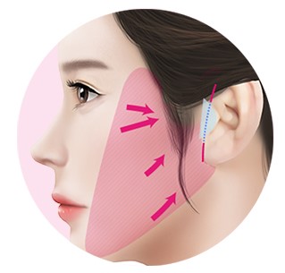 antiaging minilif 3 1
