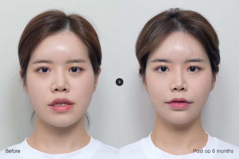 ศัลยกรรมโครงหน้าขากรรไกร ที่เกาหลี