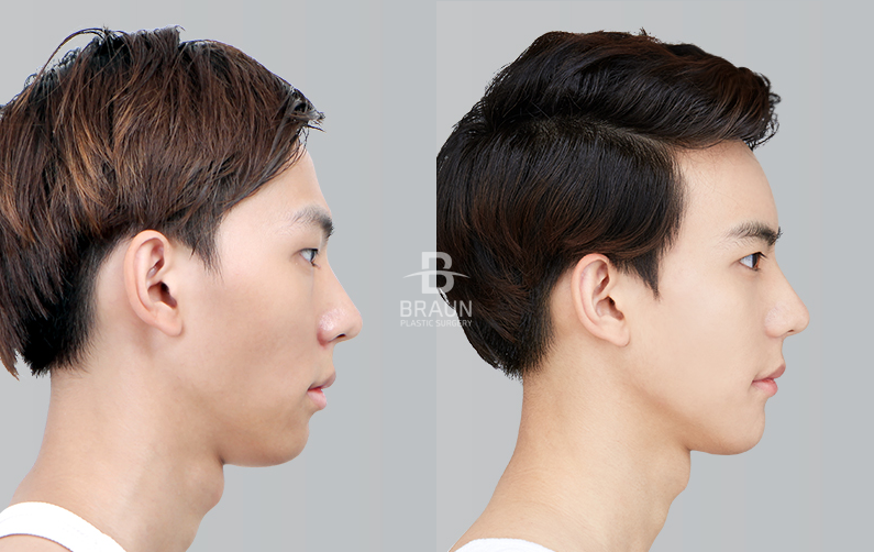 ศัลยกรรมจมูกผู้ชาย ราคาเท่าไหร่