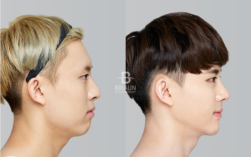 ศัลยกรรมจมูกผู้ชาย ราคาเท่าไหร่