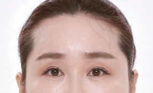 sec bna img02 after เอ็นโดไทน์คืออะไร ตัวช่วยยกกระชับ