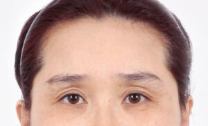 sec bna img02 before เอ็นโดไทน์คืออะไร ดีไหม ตัวช่วยยกกระชับ