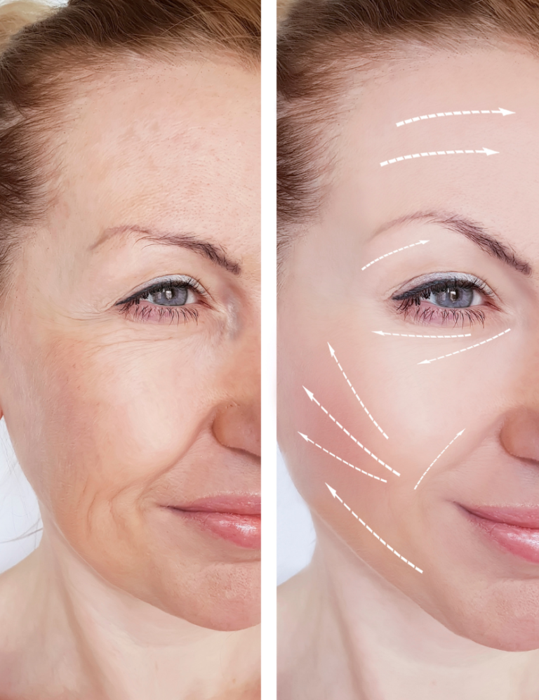 การทำศัลยกรรมที่เหมาะสม กับ คน Baby Bloomer