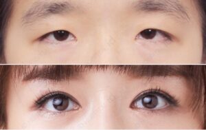 ทำชั้นตา+พร้อมเปิด ตา