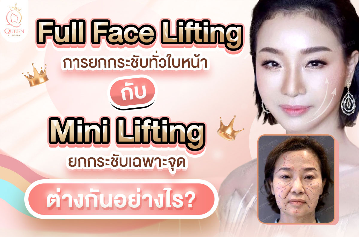 การยกกระชับทั่วใบหน้า Full Face Lifting ยกกระชับเฉพาะจุด Mini Lifting บทความ 018 การยกกระชับทั่วใบหน้า กับ ยกกระชับเฉพาะจุด 01