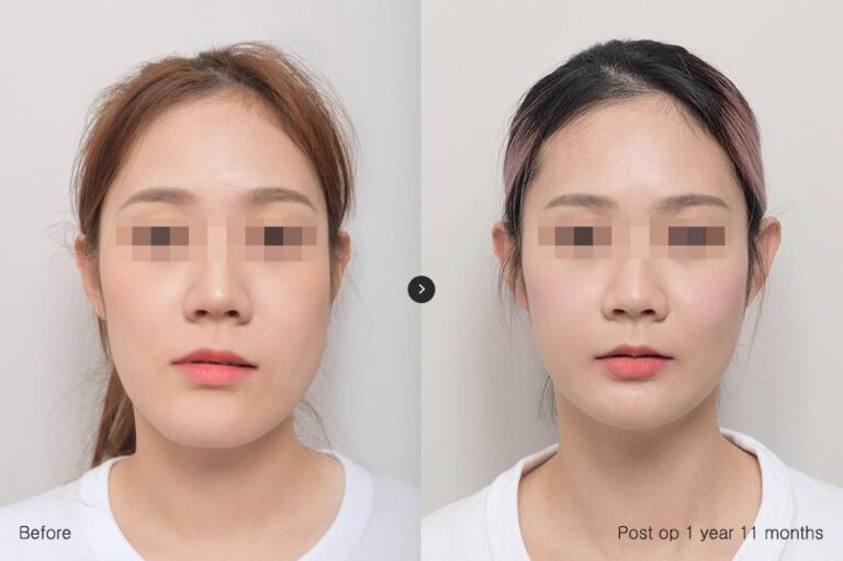 รพ.eu ผ่าตัดขากรรไกร, วีไลน์ 01