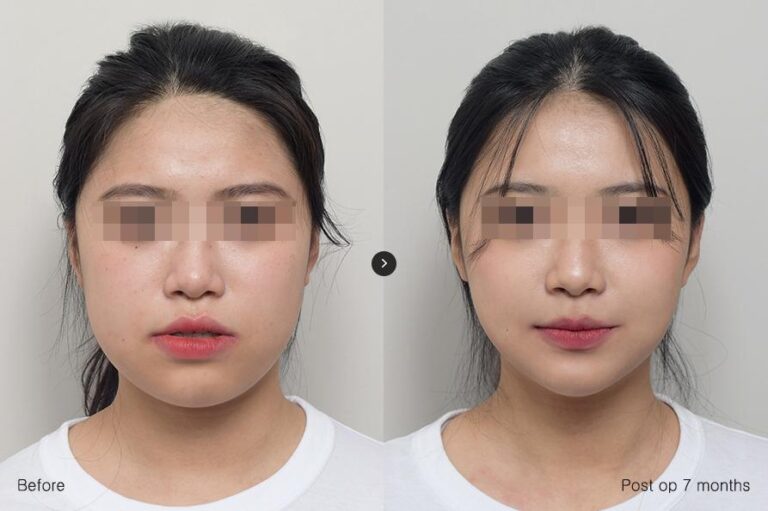 โครงหน้าขากรรไกร ศัลยกรรมเกาหลี รพ.eu ผ่าตัดขากรรไกร, วีไลน์ 02